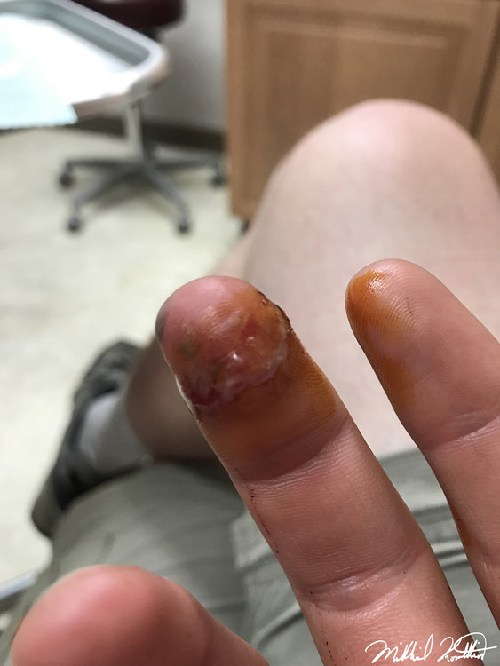 My finger after the doctor glued it. Definitely looks pretty gnarly.
