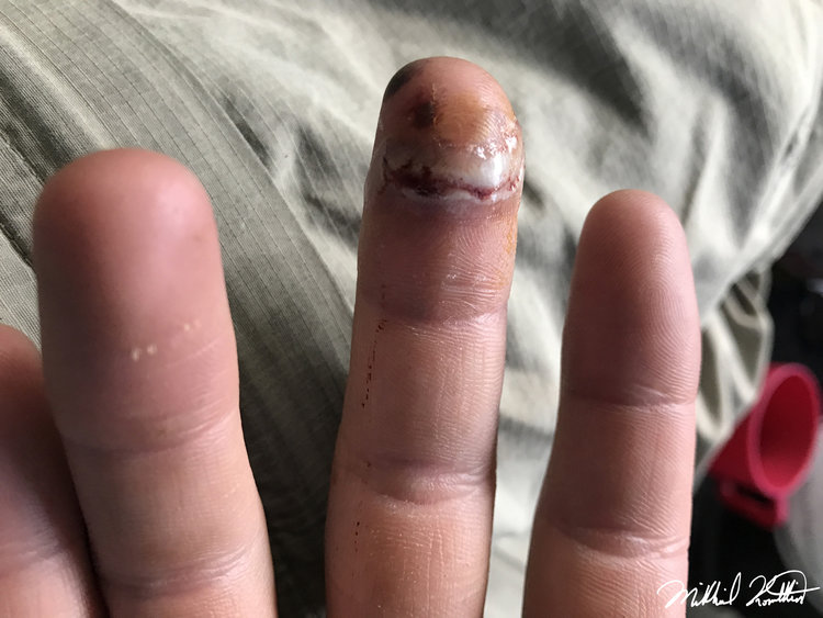 This is how my finger looked the following day. Some improvement overall. My blood blister would last for quite a while.